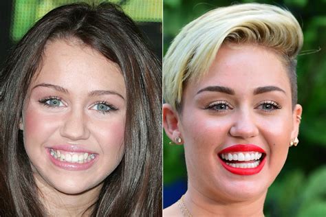 celebrity teeth whitening before and after